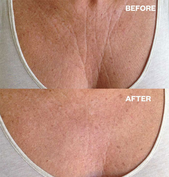 Model's chest before and after using a Chest Wrinkle Patch demonstrates a decrease in wrinkle depth