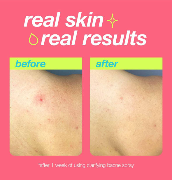 Real Skin, Real Results: Before and after comparison of a back breakout before and after 1 week of using Clarifying Bacne Spray
