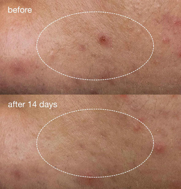 Side-by-side comparison of broken-out skin before and after 14 days of using Dermalogica Deep Acne Liquid Patch ointment