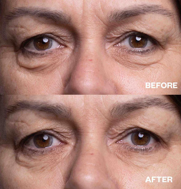Model's eyes before and after using silicone Eye Wrinkle Patches demonstrate a marked decrease in under-eye wrinkle texture