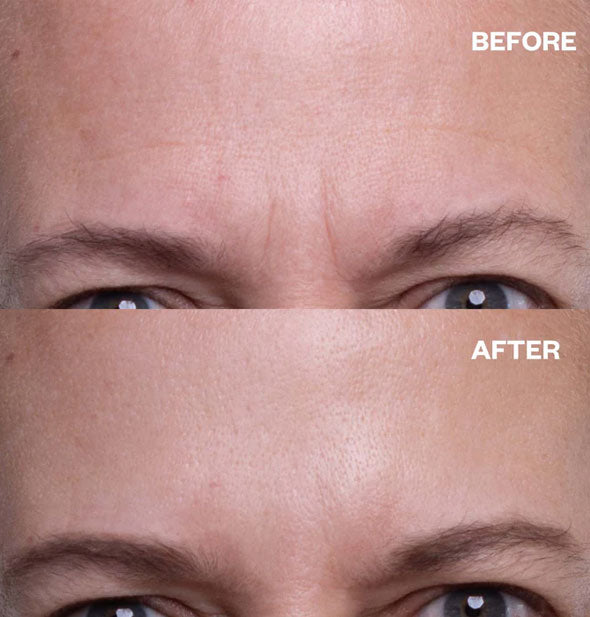 Comparison of a model's forehead before and after using silicone Forehead Wrinkle Patches demonstrates smoothed brow lines