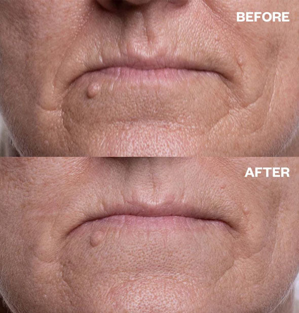 Comparison of a model's mouth area before and after using silicone Mouth & Lip Wrinkle Patches demonstrates decreased wrinkle depth
