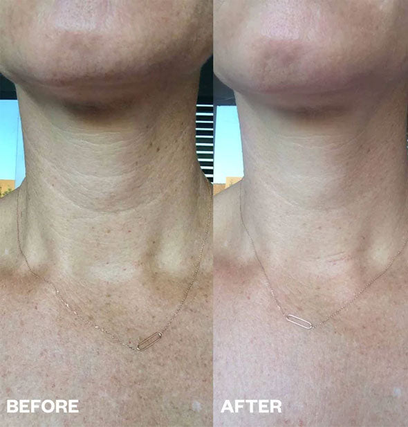 Comparison of a model's neck before and after using a silicone Neck Wrinkle Patch demonstrates decreased wrinkle depth