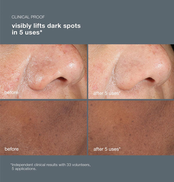 Side-by-side comparisons of clinical study volunteers' skin before and after 5 applications of Dermalogica PowerBright Dark Spot Peel