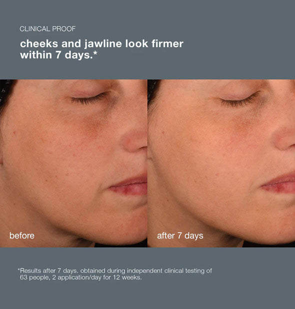 Side-by-side comparison of consumer's cheeks and jawline before and after 7 days of using Dermalogica Pro-Collagen Banking Serum demonstrate a firmer, brighter appearance