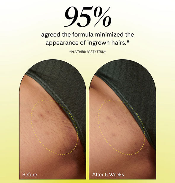 Side-by-side comparison of a consumer's bikini area before and after 6 weeks weeks of using Fur Ingrown Eliminator Serum; caption says, "95% agree the formula minimized the appearance of ingrown hairs."