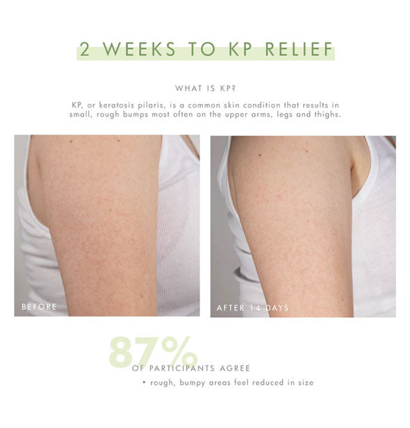 2 weeks to KP (Keratosis Pilaris) relief with before and after photos of 14 days using FarmHouse Fresh Smooth Reveal Resurfacing Silky Serum with 87% of participants agreeing rough, bumpy areas feel reduced in size