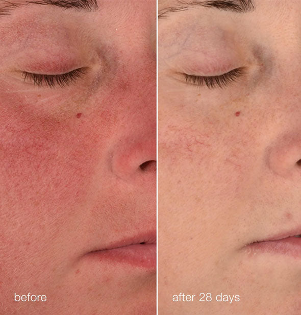 Side-by-side comparison of model's skin before and after 28 days of using Dermalogica Stabilizing Repair Cream