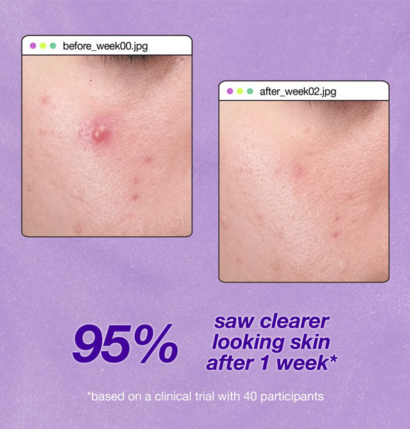 Images showing an area of broken-out skin before and after a week of using Dermalogica Clear Start Breakout Clearing Liquid Peel is labeled, "95% saw clearer looking skin after 1 week* based on a clinical trial with 50 participants"