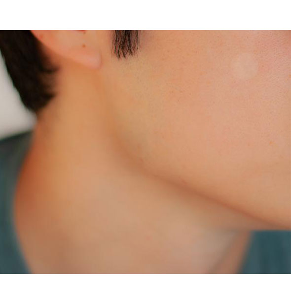 An Ollie Belle Cover Dot Acne Care patch shown on a model's cheek