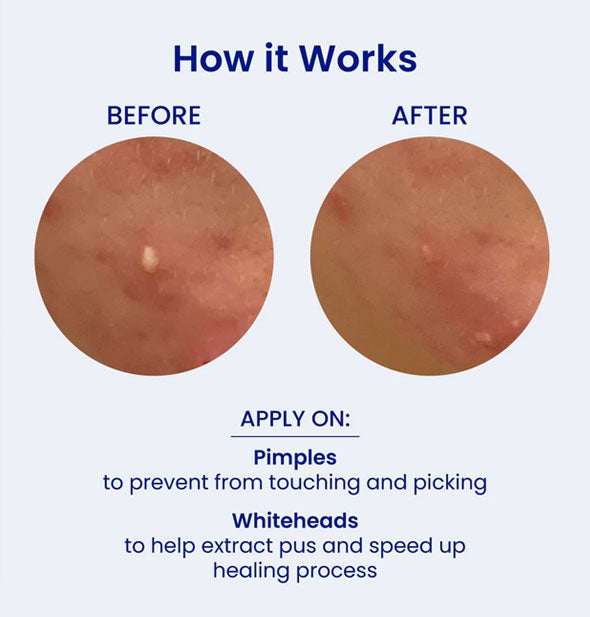Pimple closeups before and after using FaceTory Spot Fighter Blemish Patches